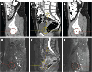 Significant Publication: The Effect Of Pelvic Incidence On Outcomes 