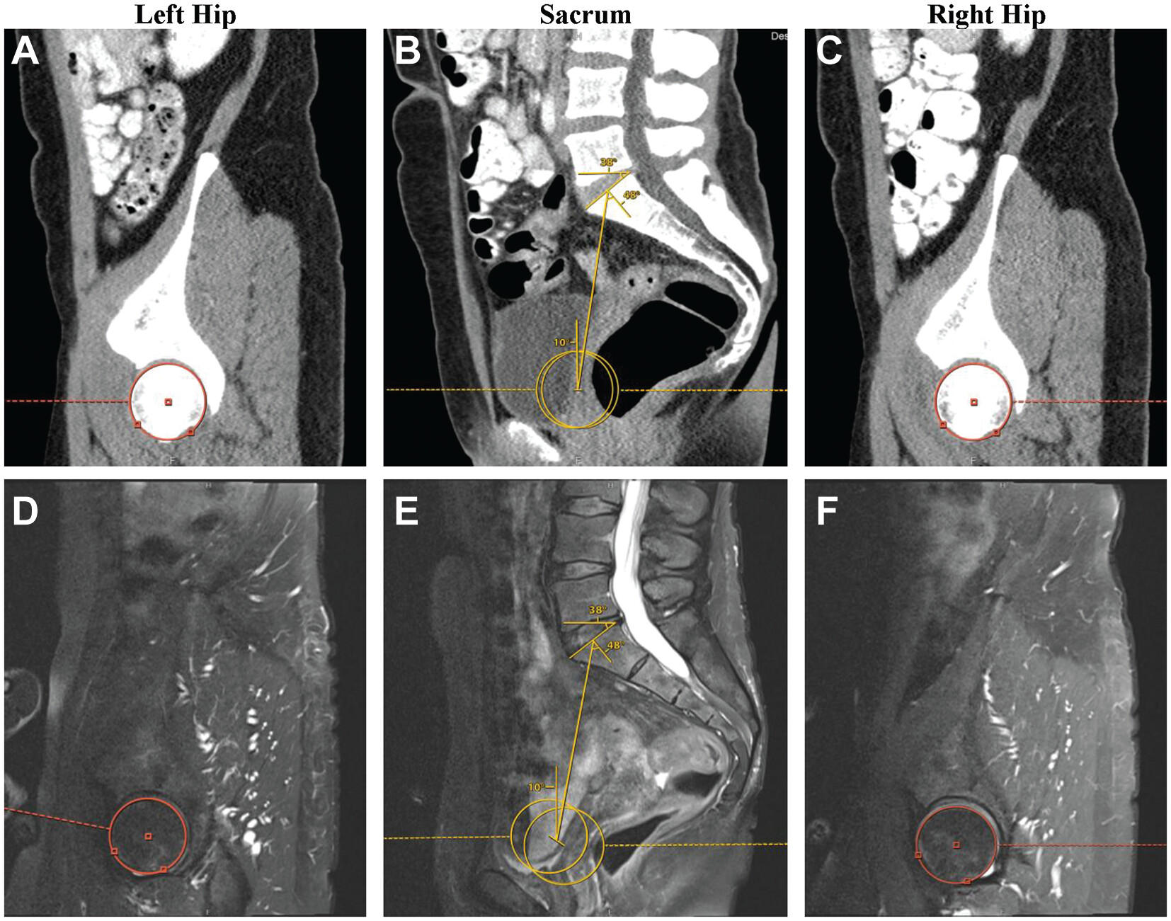 Significant Publication: The Effect of Pelvic Incidence on Outcomes ...